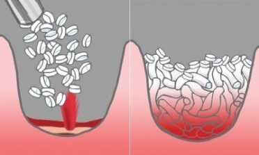 Before and After - Small sponges are injected into the wound, and the bleeding stops within seconds.