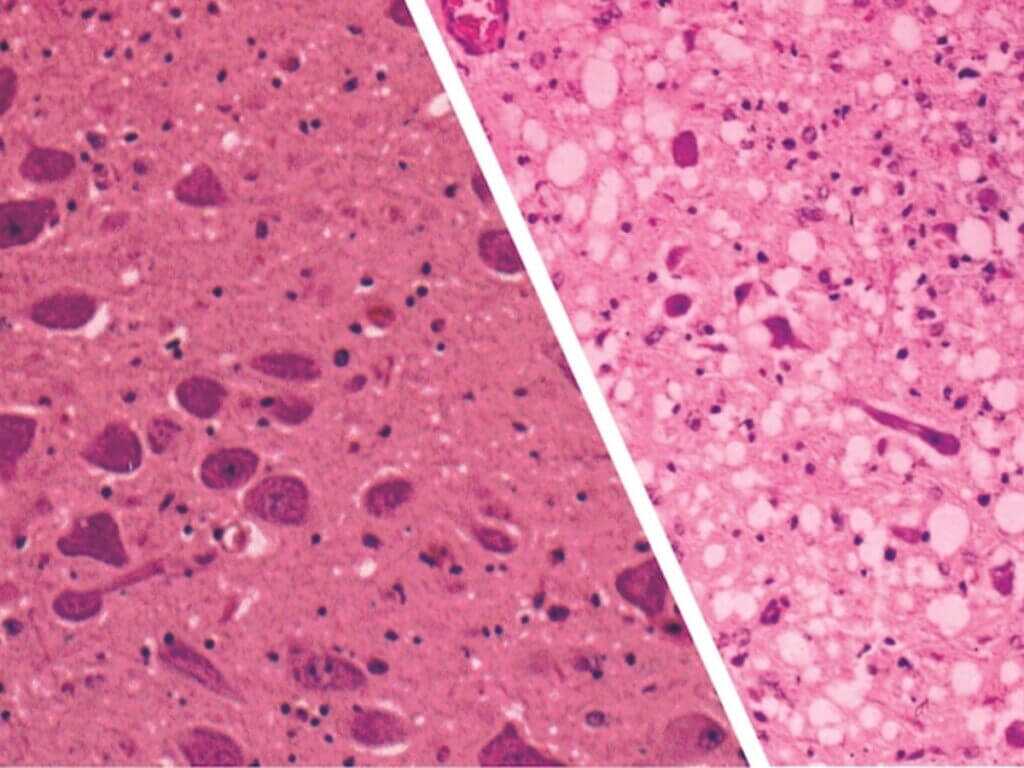 Healthy deer brain tissue compared to CWD-infected brain tissue