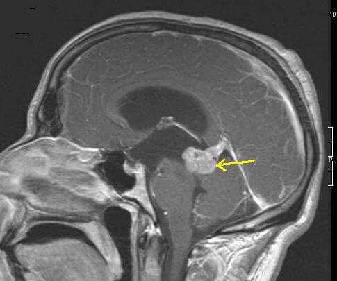 Astrocytoma brain tumor similar in location to the lesion found after Charles Whitman autopsy
