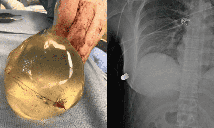 Woman’s Breast Implant Deflects .40-Caliber Bullet, Saving Her Life Woman’s Breast Implant Deflects .40-Caliber Bullet, Saving Her Life