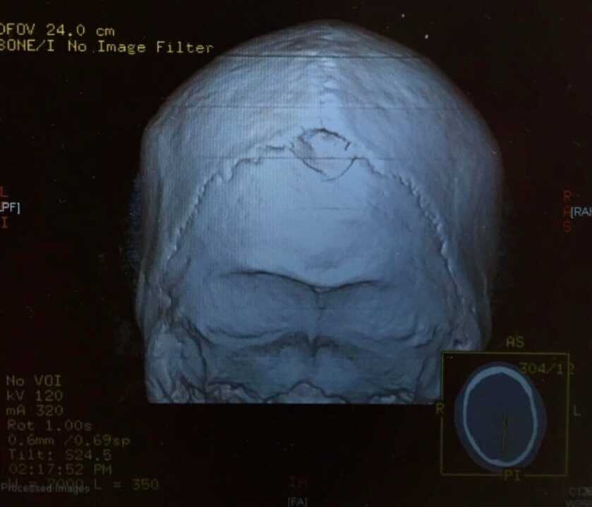 The Life and Times of the Brain-Damaged Gunslinger Clay Allison The Life and Times of the Brain-Damaged Gunslinger Clay Allison