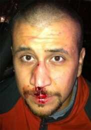 No DOJ Charges for Zimmerman After photos like this began to circulate, a DOJ case against Zimmerman seemed unlikely. But now the news is official.