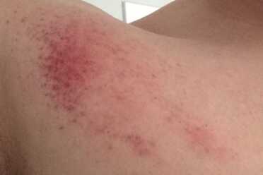 After working with the bump fire, you may want to show your wife the actual waffle pattern of the bruise so she doesn't think you have been getting hickies from Mick Jagger. 