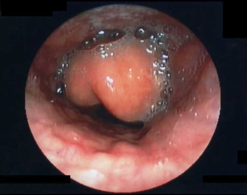 Epiglottitis, the infection that very well may have killed George Washington