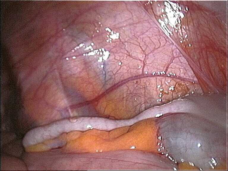 Human vermiform appendix illustrating the organ at the center of the USS Seadragon emergency surgery