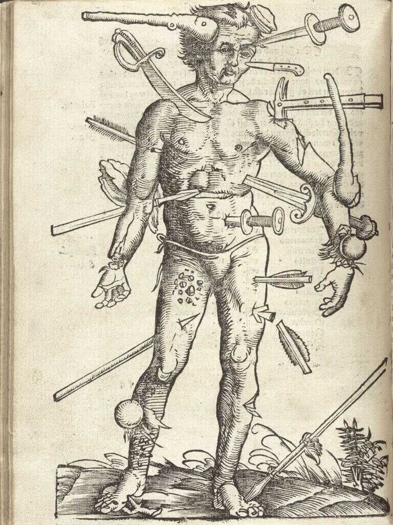 Historic wartime medical treatment illustrating the challenges of repairing battlefield injuries