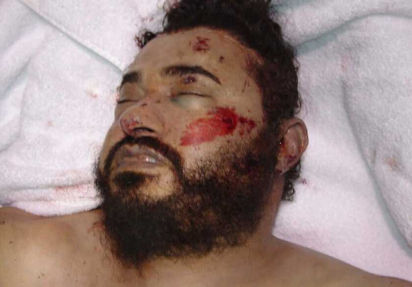 bearded man with beat up face laying on a towel